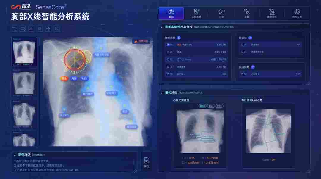 商汤医疗携手印尼Siloam落地SenseCare胸部X光智能分析解决方案(图1) 92a7d55c-114e-11f1-90a1-92fbcf53809c.png